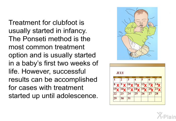 Treatment for clubfoot is usually started in infancy. The Ponseti method is the most common treatment option and is usually started in a baby's first two weeks of life. However, successful results can be accomplished for cases with treatment started up until adolescence.