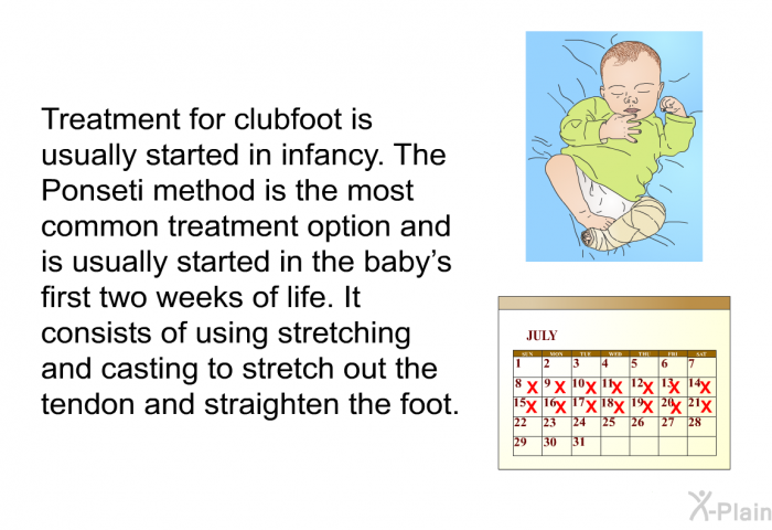 Treatment for clubfoot is usually started in infancy. The Ponseti method is the most common treatment option and is usually started in the baby's first two weeks of life. It consists of using stretching and casting to stretch out the tendon and straighten the foot.