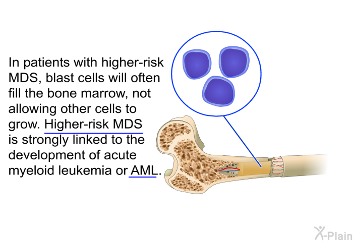 In patients with higher-risk MDS, blast cells will often fill the bone marrow, not allowing other cells to grow. Higher-risk MDS is strongly linked to the development of acute myeloid leukemia or AML.