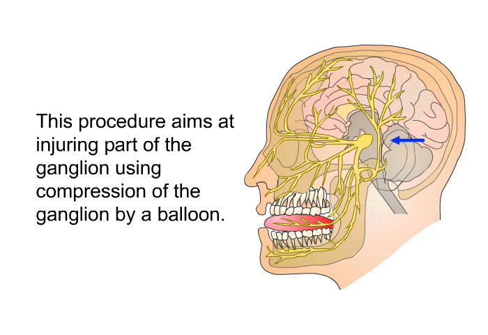 This procedure aims at injuring part of the ganglion using compression of the ganglion by a balloon.