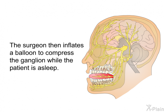 The surgeon then inflates a balloon to compress the ganglion while the patient is asleep.