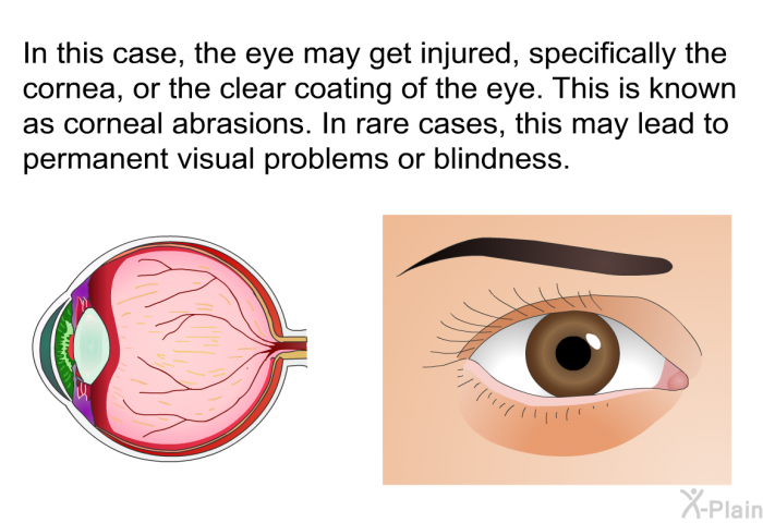 In this case, the eye may get injured, specifically the cornea, or the clear coating of the eye. This is known as corneal abrasions. In rare cases, this may lead to permanent visual problems or blindness.