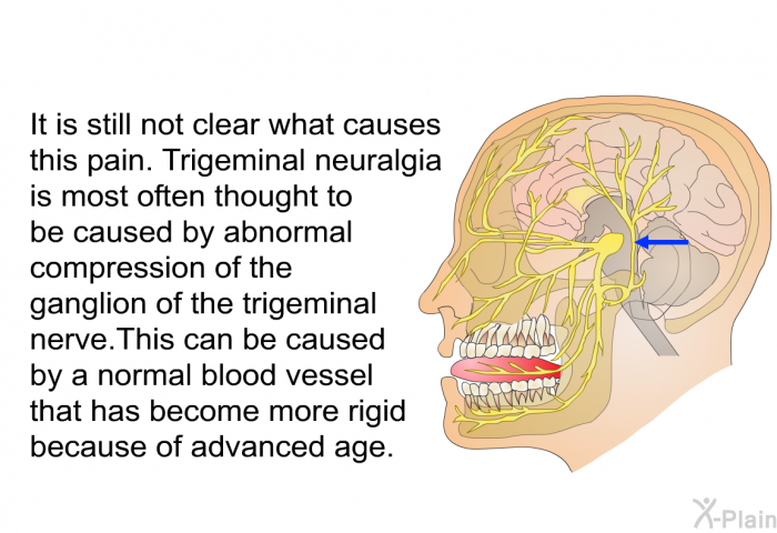 It is still not clear what causes this pain. Trigeminal neuralgia is most often thought to be caused by abnormal compression of the ganglion of the trigeminal nerve. This can be caused by a normal blood vessel that has become more rigid because of advanced age.
