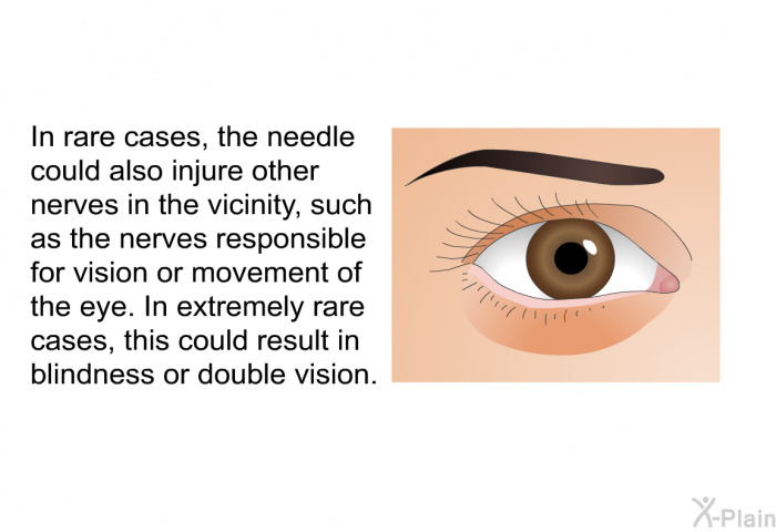 In rare cases, the needle could also injure other nerves in the vicinity, such as the nerves responsible for vision or movement of the eye. In extremely rare cases, this could result in blindness or double vision.