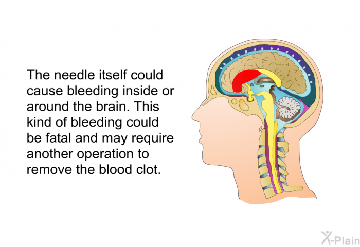 The needle itself could cause bleeding inside or around the brain. This kind of bleeding could be fatal and may require another operation to remove the blood clot.