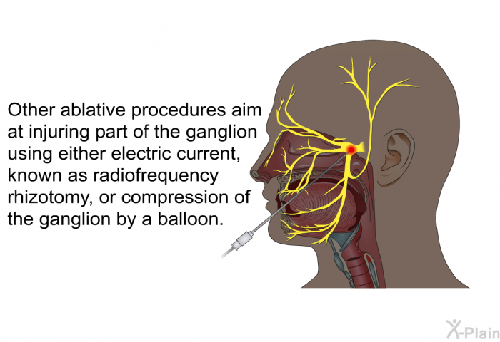 Other ablative procedures aim at injuring part of the ganglion using either electric current, known as radiofrequency rhizotomy, or compression of the ganglion by a balloon.