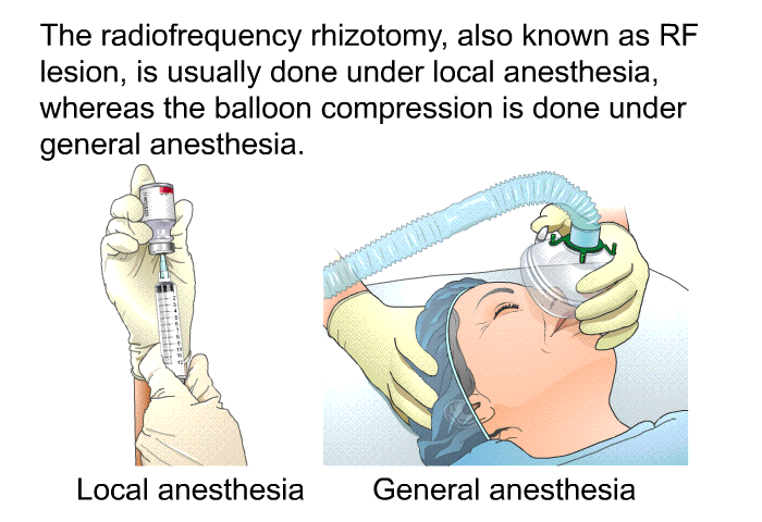 The radiofrequency rhizotomy, also known as RF lesion, is usually done under local anesthesia, whereas the balloon compression is done under general anesthesia.