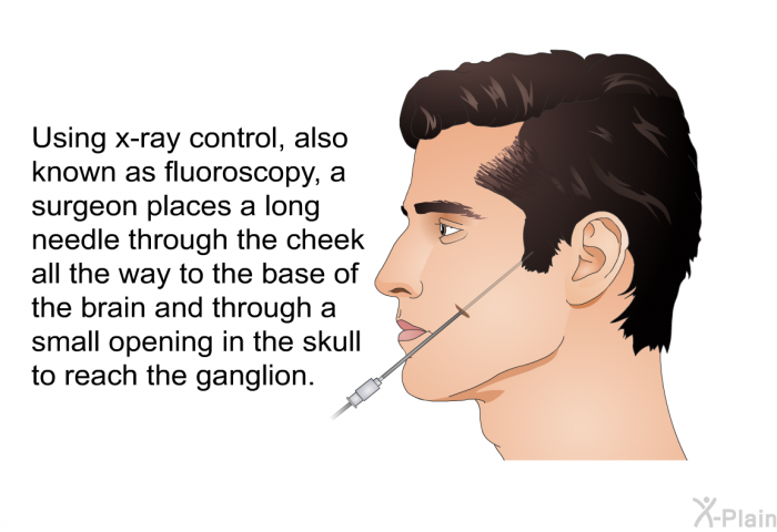 Using x-ray control, also known as fluoroscopy, a surgeon places a long needle through the cheek all the way to the base of the brain and through a small opening in the skull to reach the ganglion.