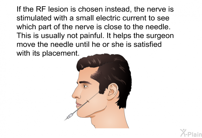 If the RF lesion is chosen instead, the nerve is stimulated with a small electric current to see which part of the nerve is close to the needle. This is usually not painful. It helps the surgeon move the needle until he or she is satisfied with its placement.