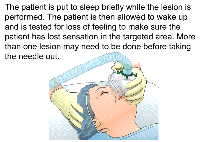 The patient is put to sleep briefly while the lesion is performed. The patient is then allowed to wake up and is tested for loss of feeling to make sure the patient has lost sensation in the targeted area. More than one lesion may need to be done before taking the needle out.