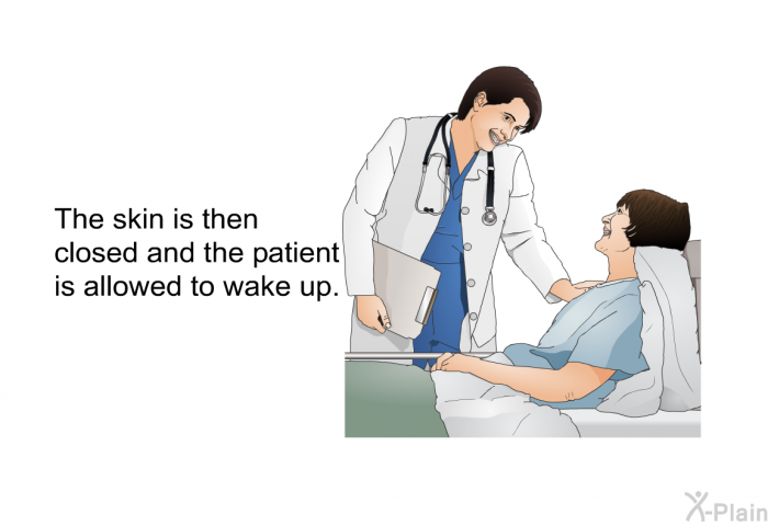 The skin is then closed and the patient is allowed to wake up.
