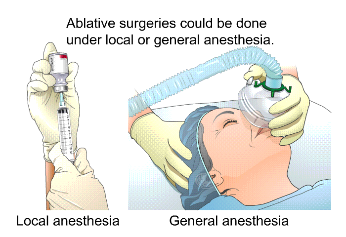 Ablative surgeries could be done under local or general anesthesia.