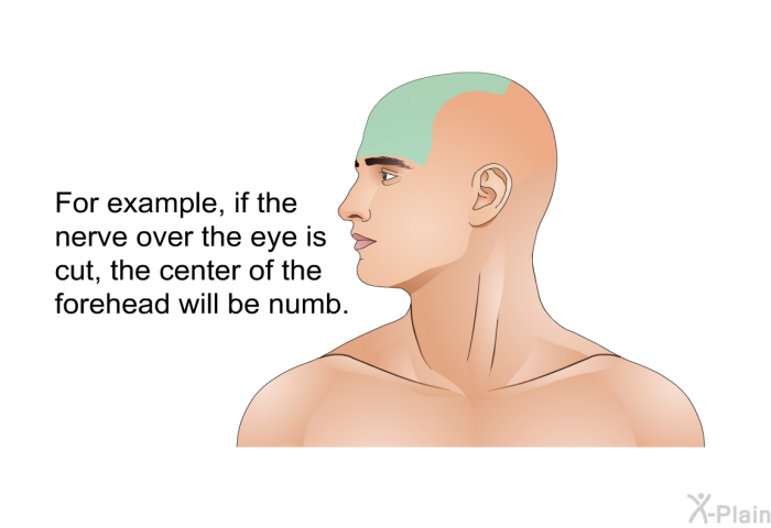 For example, if the nerve over the eye is cut, the center of the forehead will be numb.