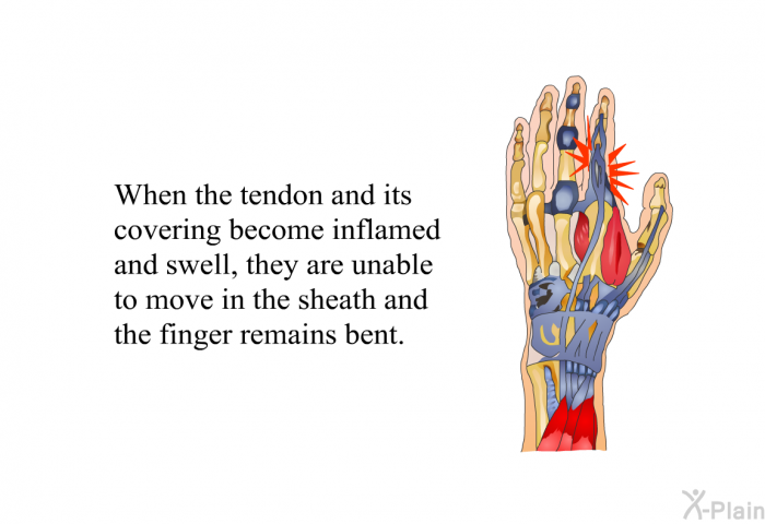 When the tendon and its covering become inflamed and swell, they are unable to move in the sheath and the finger remains bent.