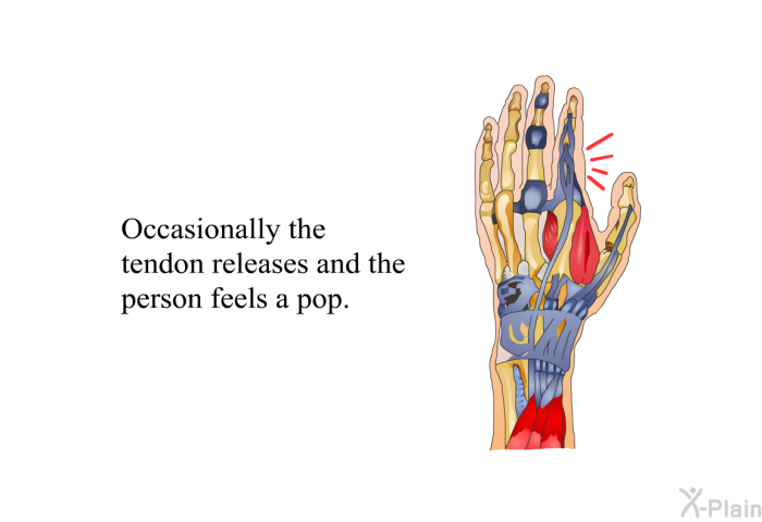 Occasionally the tendon releases and the person feels a pop.