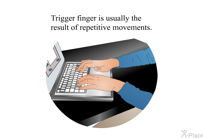 Trigger finger is usually the result of repetitive movements.