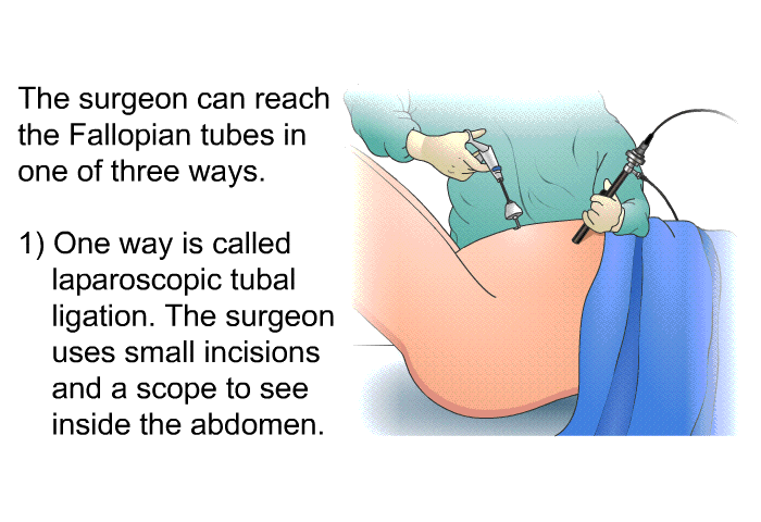The surgeon can reach the Fallopian tubes in one of three ways.  One way is called laparoscopic tubal ligation. The surgeon uses small incisions and a scope to see inside the abdomen.
