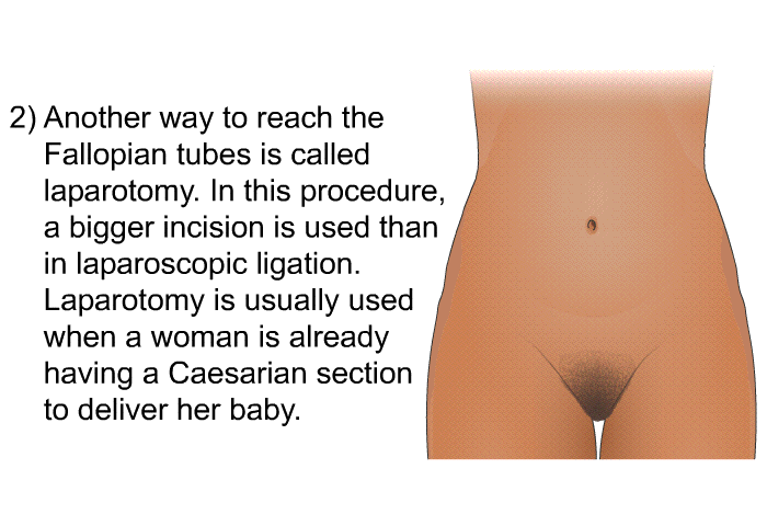 Another way to reach the Fallopian tubes is called laparotomy. In this procedure, a bigger incision is used than in laparoscopic ligation. Laparotomy is usually used when a woman is already having a Caesarian section to deliver her baby.