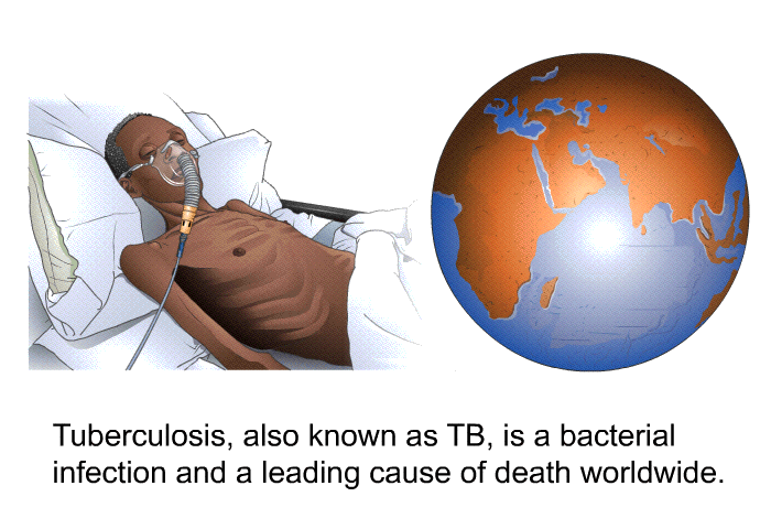 Tuberculosis, also known as TB, is a bacterial infection and a leading cause of death worldwide.