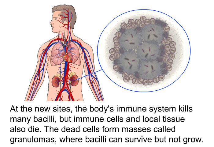 At the new sites, the body's immune system kills many bacilli, but immune cells and local tissue also die. The dead cells form masses called granulomas, where bacilli can survive but not grow.