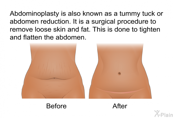 Abdominoplasty is also known as a tummy tuck or abdomen reduction. It is a surgical procedure to remove loose skin and fat. This is done to tighten and flatten the abdomen.