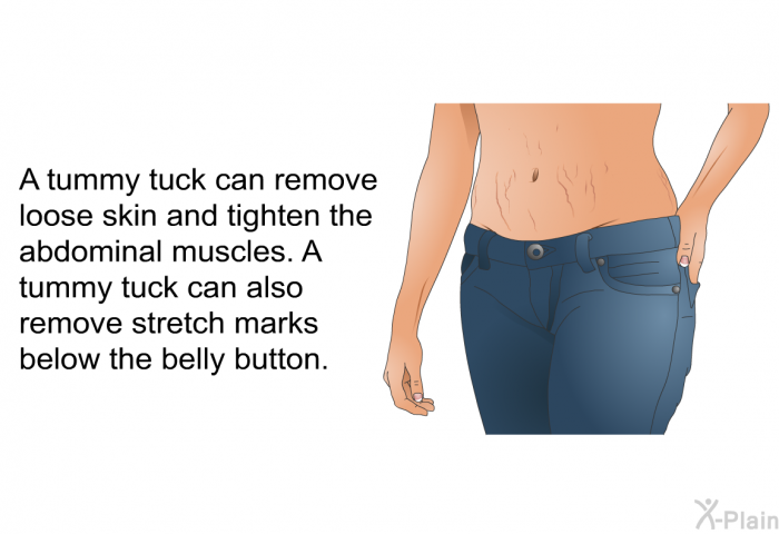 A tummy tuck can remove loose skin and tighten the abdominal muscles. A tummy tuck can also remove stretch marks below the belly button.