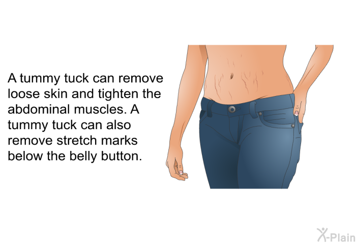 A tummy tuck can remove loose skin and tighten the abdominal muscles. A tummy tuck can also remove stretch marks below the belly button.