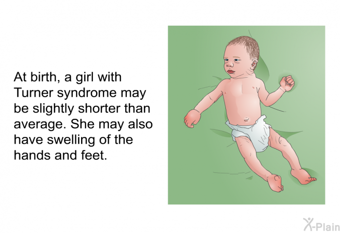 At birth, a girl with Turner syndrome may be slightly shorter than average. She may also have swelling of the hands and feet.