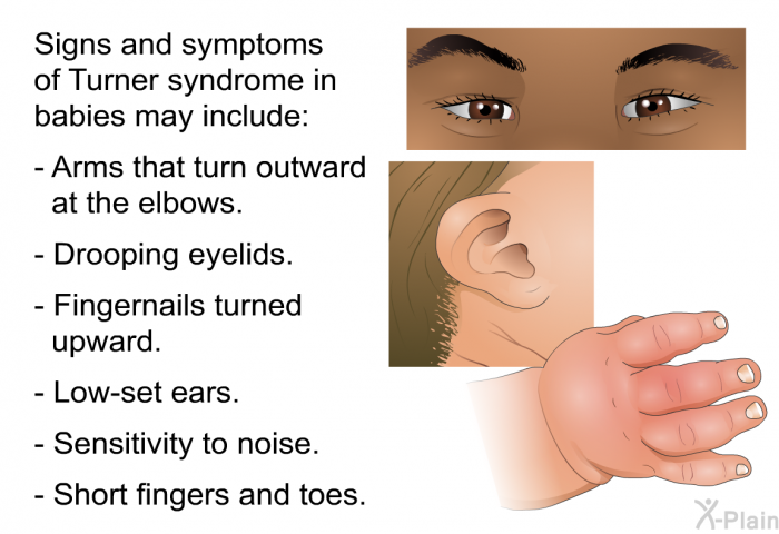 Signs and symptoms of Turner syndrome in babies may include:  Arms that turn outward at the elbows. Drooping eyelids. Fingernails turned upward. Low-set ears. Sensitivity to noise. Short fingers and toes.