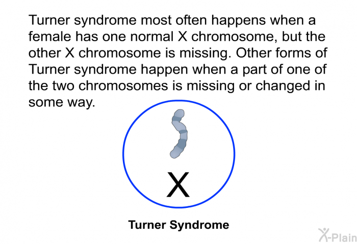 Turner syndrome most often happens when a female has one normal X chromosome, but the other X chromosome is missing. Other forms of Turner syndrome happen when a part of one of the two chromosomes is missing or changed in some way.