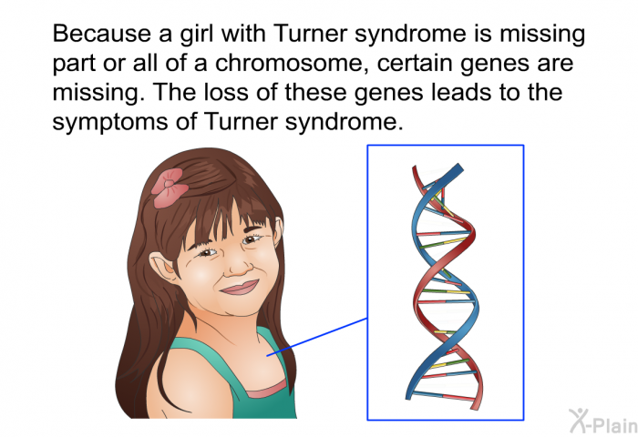 Because a girl with Turner syndrome is missing part or all of a chromosome, certain genes are missing. The loss of these genes leads to the symptoms of Turner syndrome.