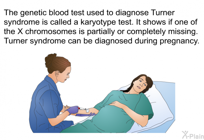 The genetic blood test used to diagnose Turner syndrome is called a karyotype test. It shows if one of the X chromosomes is partially or completely missing. Turner syndrome can be diagnosed during pregnancy.
