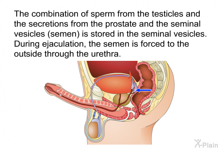 The combination of sperm from the testicles and the secretions from the prostate and the seminal vesicles (semen) is stored in the seminal vesicles. During ejaculation, the semen is forced to the outside through the urethra.