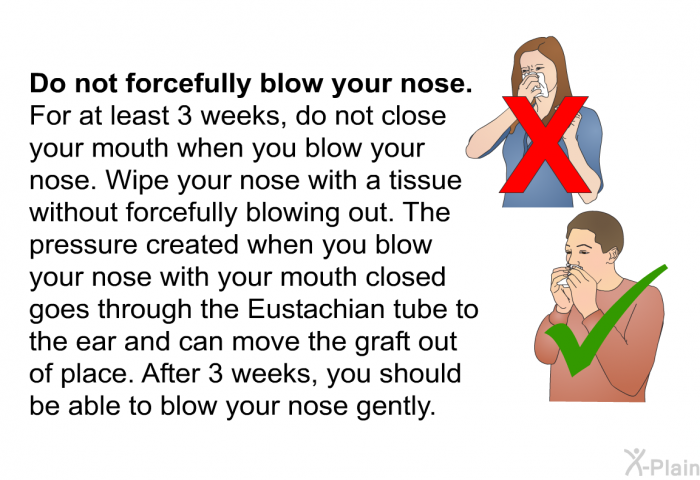 <B>Do not forcefully blow your nose</B>.
For at least 3 weeks, do not close your mouth when you blow your nose. Wipe your nose with a tissue without forcefully blowing out. The pressure created when you blow your nose with your mouth closed goes through the Eustachian tube to the ear and can move the graft out of place. After 3 weeks, you should be able to blow your nose gently.