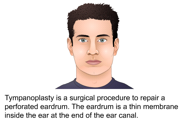 Tympanoplasty is a surgical procedure to repair a perforated eardrum. The eardrum is a thin membrane inside the ear at the end of the ear canal.