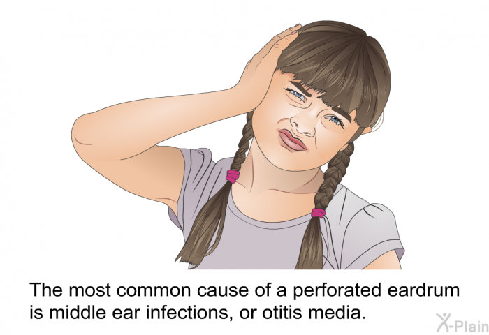 The most common cause of a perforated eardrum is middle ear infections, or otitis media.
