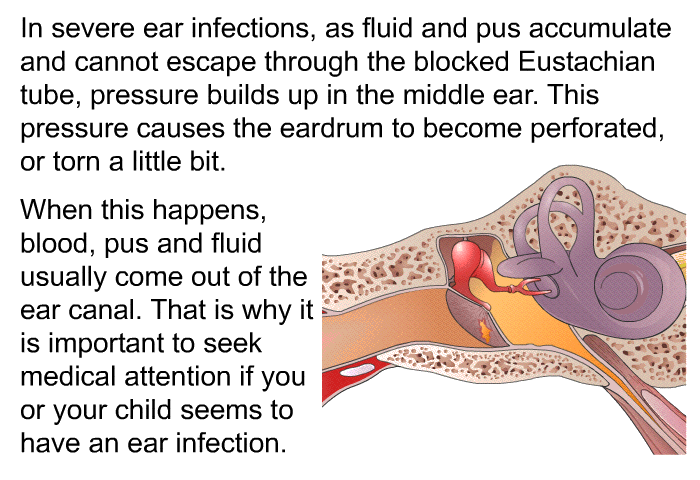 In severe ear infections, as fluid and pus accumulate and cannot escape through the blocked Eustachian tube, pressure builds up in the middle ear. This pressure causes the eardrum to become perforated, or torn a little bit. When this happens, blood, pus and fluid usually come out of the ear canal. That is why it is important to seek medical attention if you or your child seems to have an ear infection.