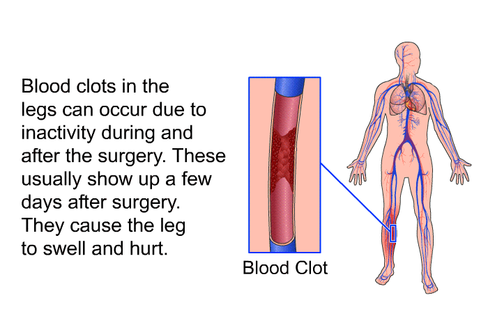Blood clots in the legs can occur due to inactivity during and after the surgery. These usually show up a few days after surgery. They cause the leg to swell and hurt.