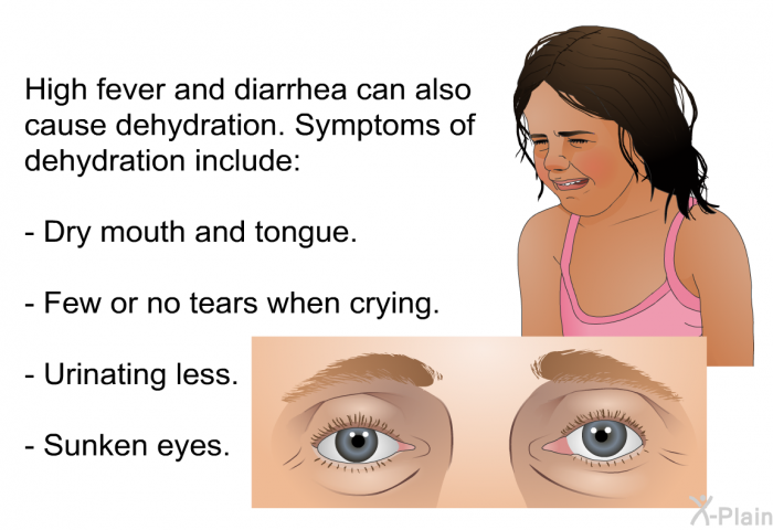 High fever and diarrhea can also cause dehydration. Symptoms of dehydration include:  Dry mouth and tongue. Few or no tears when crying. Urinating less. Sunken eyes.
