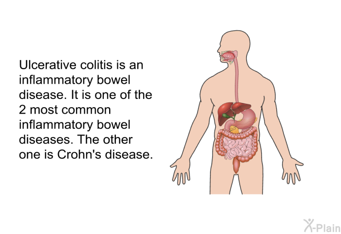 Ulcerative colitis is an inflammatory bowel disease. It is one of the 2 most common inflammatory bowel diseases. The other one is Crohn's disease.
