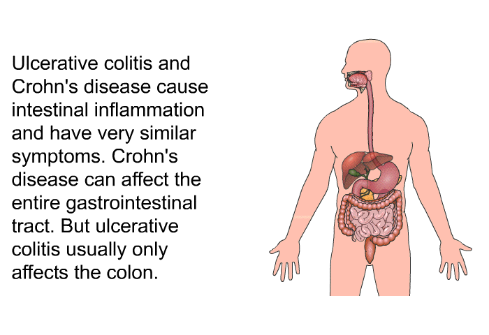 Ulcerative colitis and Crohn's disease cause intestinal inflammation and have very similar symptoms. Crohn's disease can affect the entire gastrointestinal tract. But ulcerative colitis usually only affects the colon.