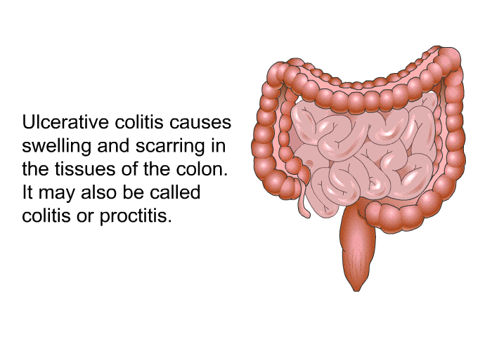 Ulcerative colitis causes swelling and scarring in the tissues of the colon. It may also be called colitis or proctitis.