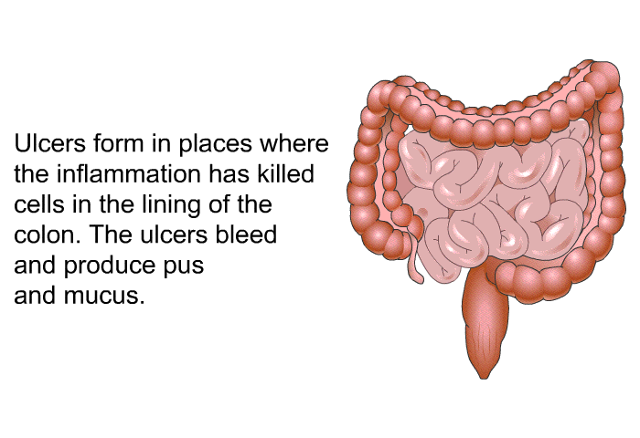 Ulcers form in places where the inflammation has killed cells in the lining of the colon. The ulcers bleed and produce pus and mucus.