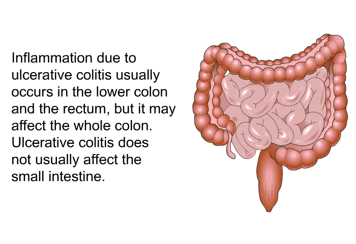 Inflammation due to ulcerative colitis usually occurs in the lower colon and the rectum, but it may affect the whole colon. Ulcerative colitis does not usually affect the small intestine.