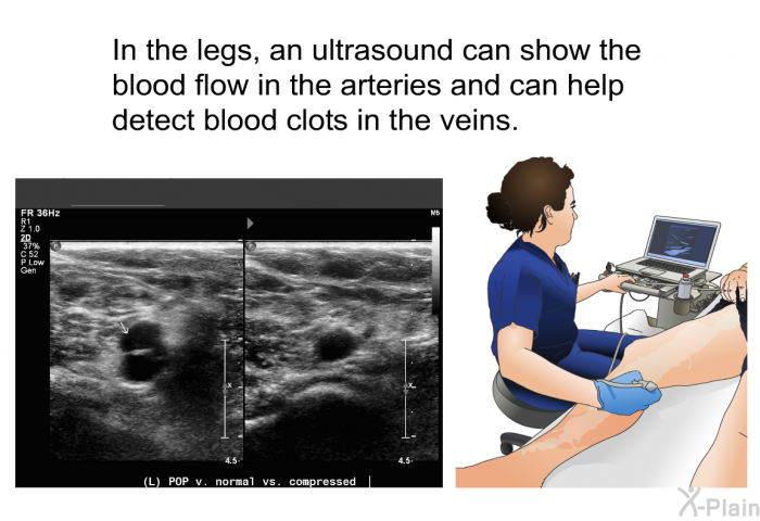 In the legs, an ultrasound can show the blood flow in the arteries and can help detect blood clots in the veins.