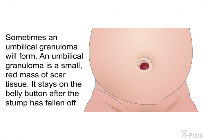 Sometimes an umbilical granuloma will form. An umbilical granuloma is a small, red mass of scar tissue. It stays on the belly button after the stump has fallen off.