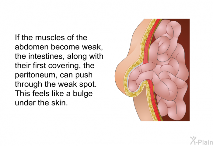 If the muscles of the abdomen become weak, the intestines, along with their first covering, the peritoneum, can push through the weak spot. This feels like a bulge under the skin.