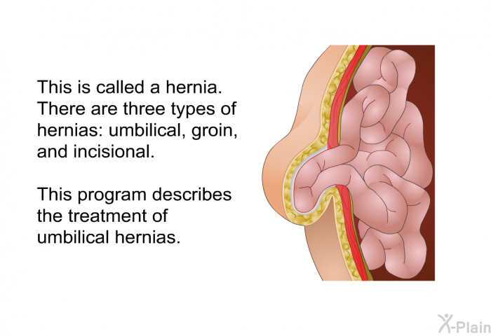 This is called a hernia. There are three types of hernias: umbilical, groin and incisional. This program describes the treatment of umbilical hernias.