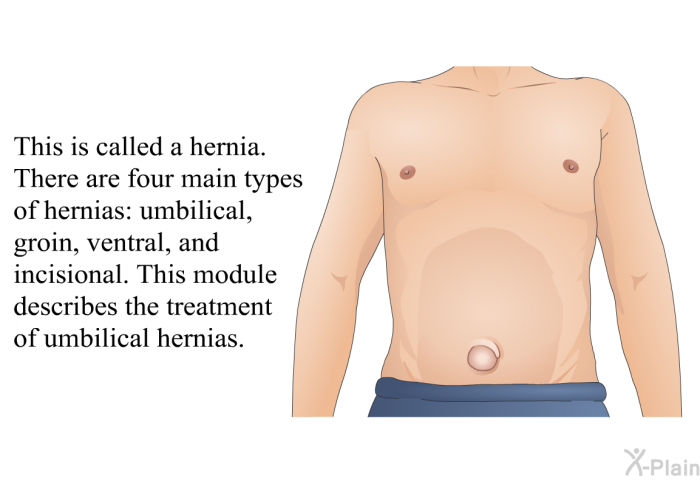 This is called a hernia. There are four main types of hernias: umbilical, groin, ventral, and incisional. This module describes the treatment of umbilical hernias.