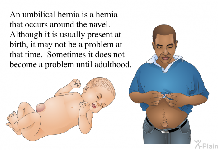 An umbilical hernia is a hernia that occurs around the navel. Although it is usually present at birth, it may not be a problem at that time. Sometimes it does not become a problem until adulthood.
